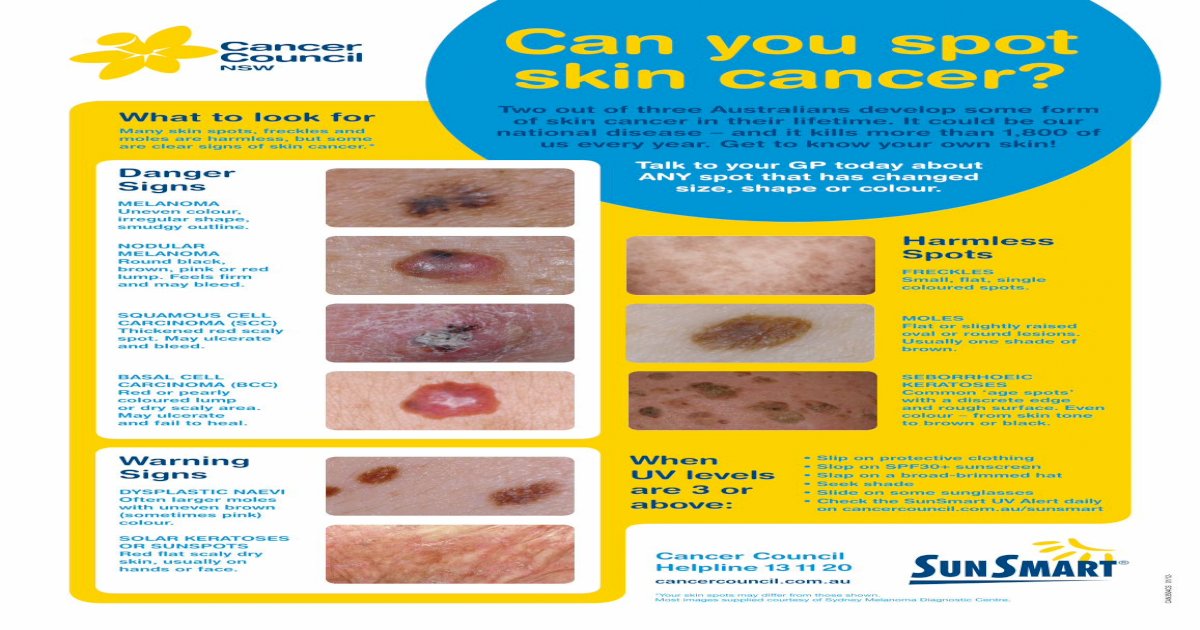 Can you spot skin cancer? · spot. May ulcerate and bleed. BASAL CELL ...