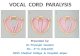 Vocal  cord  paralysis