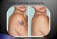 Laser Tattoo Removal Los Angeles | Tattoo Removal Los Angeles