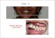 Clear Path Aligners - Patient Experience Case 1