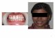 Invisible Braces Treatment | Orthodontic Braces bangalote