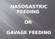 NASOGASTRIC FEEDING  OR  GAVAGE  FEEDING