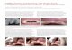 MIMI -Flapless Implantation with Single-Tooth Champions Implant … · 2019-01-03 · restorations are more affordable for patients than conventional implantation (total price: 135